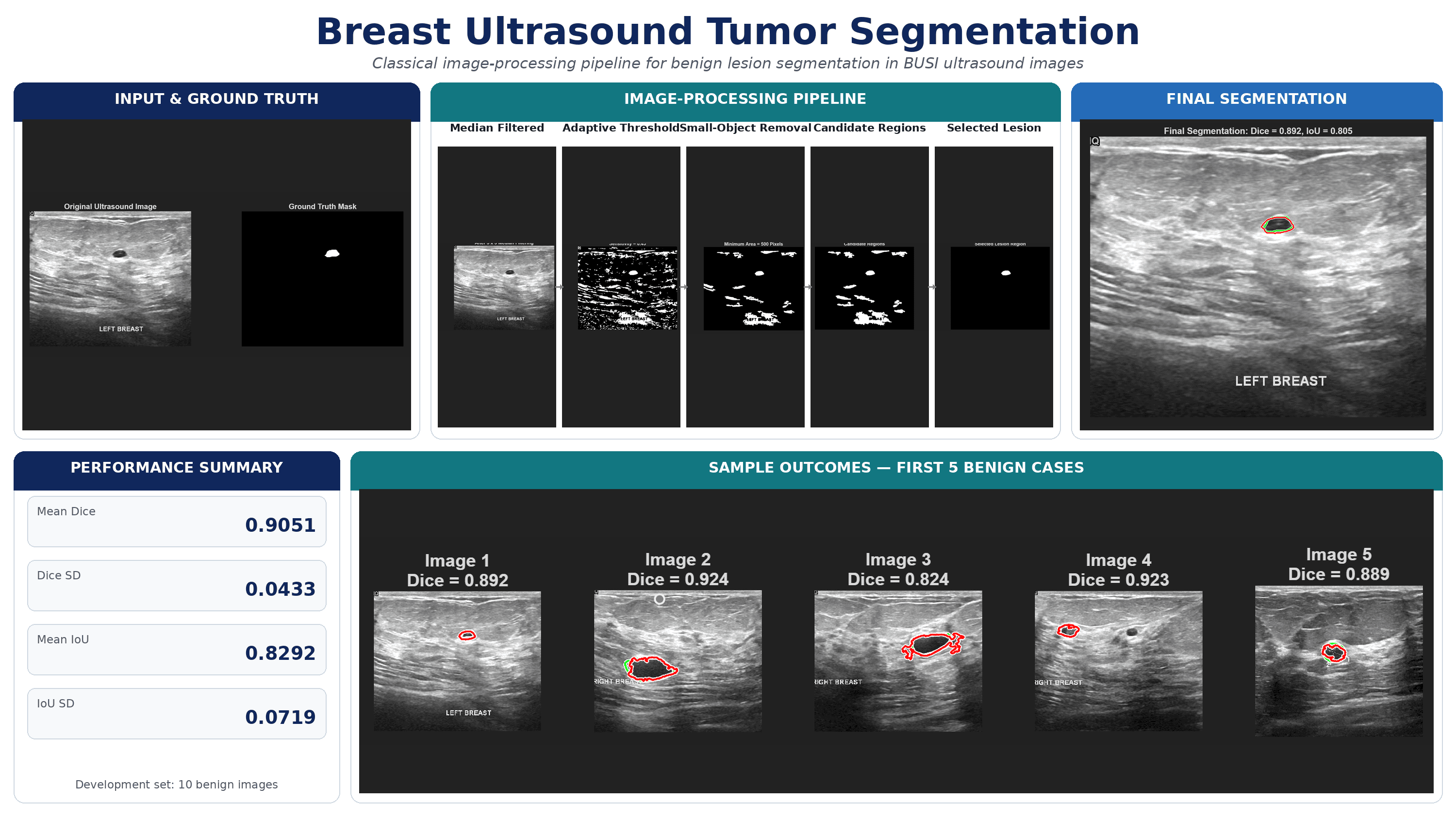 Breast Ultrasound Tumor Segmentation